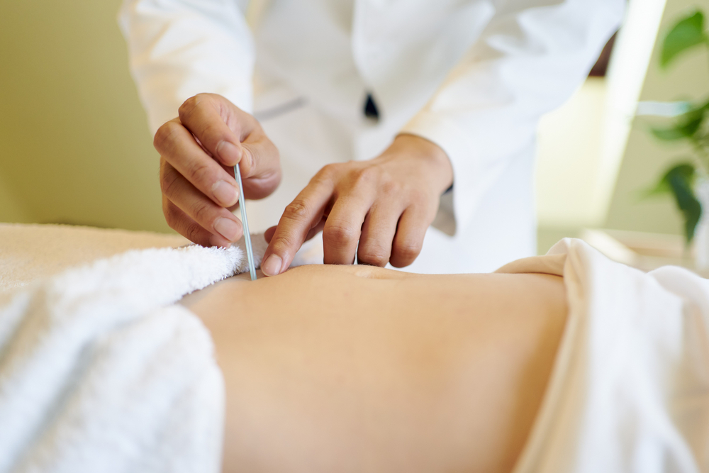 Dry needling treatment.